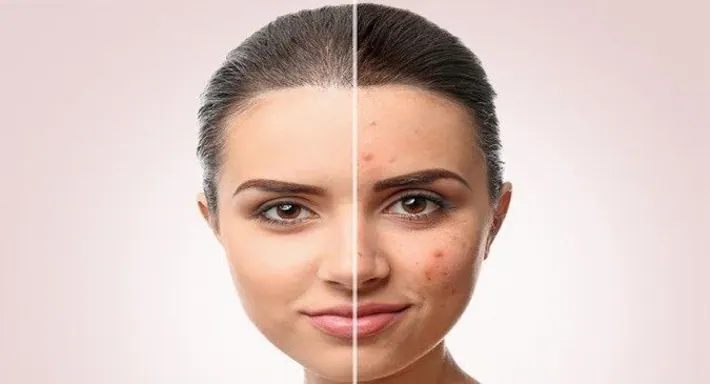 Read more about the article Skin Acne Wegera