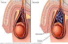 Read more about the article Varicocele