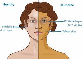 Read more about the article Jaundice