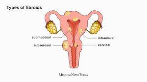 You are currently viewing fibroids