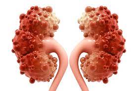 Read more about the article Renal Cyst