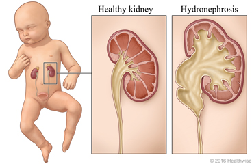 Read more about the article Hydronephrosis