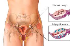 Polycystic ovarian disease (PCOD)