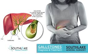 You are currently viewing Gallstones